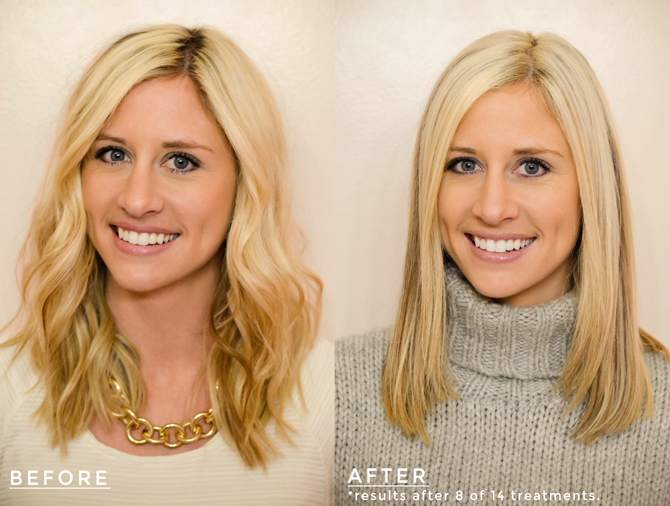 crest teeth whitening strips before and after