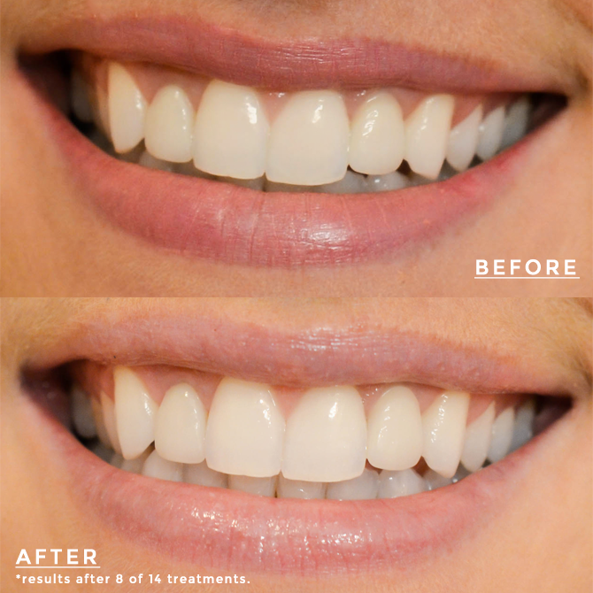 crest sensitive white strips before and after